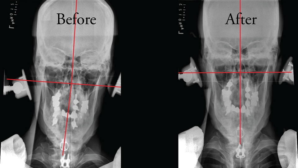 X-ray showing Anchorage chiropractor correction of cervical neck and head
