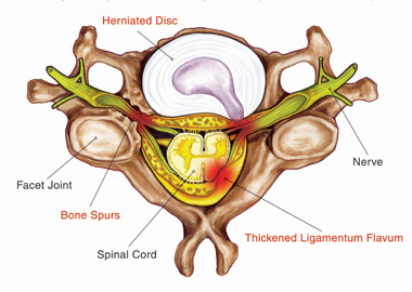 cervical neck vertebra illustrating potential sources of migraine headache pain