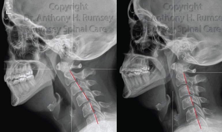 upper cervical chiropractic before and after correction
