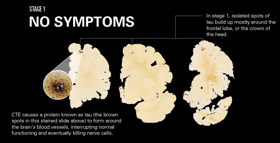 concussion often shows no symptoms immediately